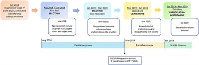 Subacute Cutaneous Lupus Erythematosus-Like Eruption Induced by EGFR -Tyrosine Kinase Inhibitor in EGFR-Mutated Non-small Cell Lung Cancer: A Case Report